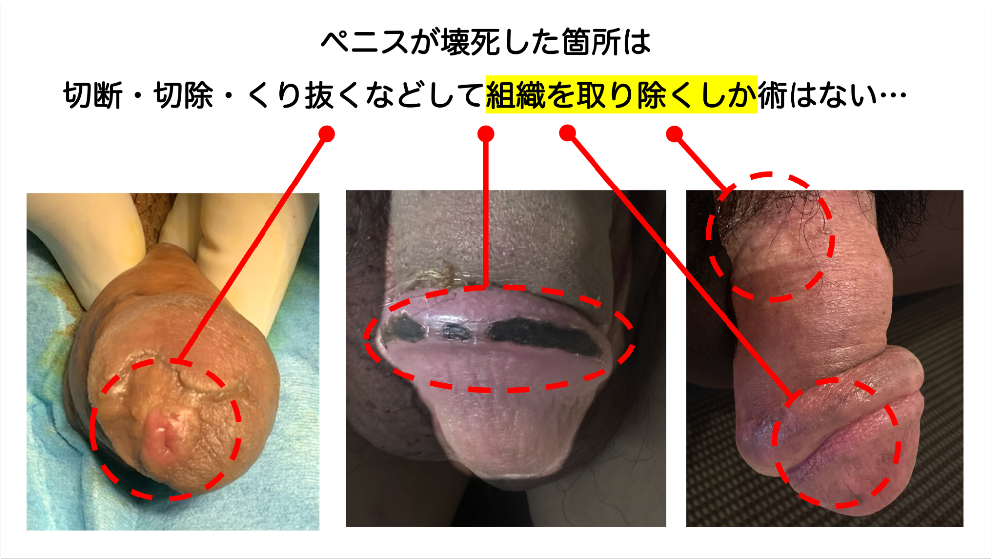 実際に亀頭が壊死してしまった症例