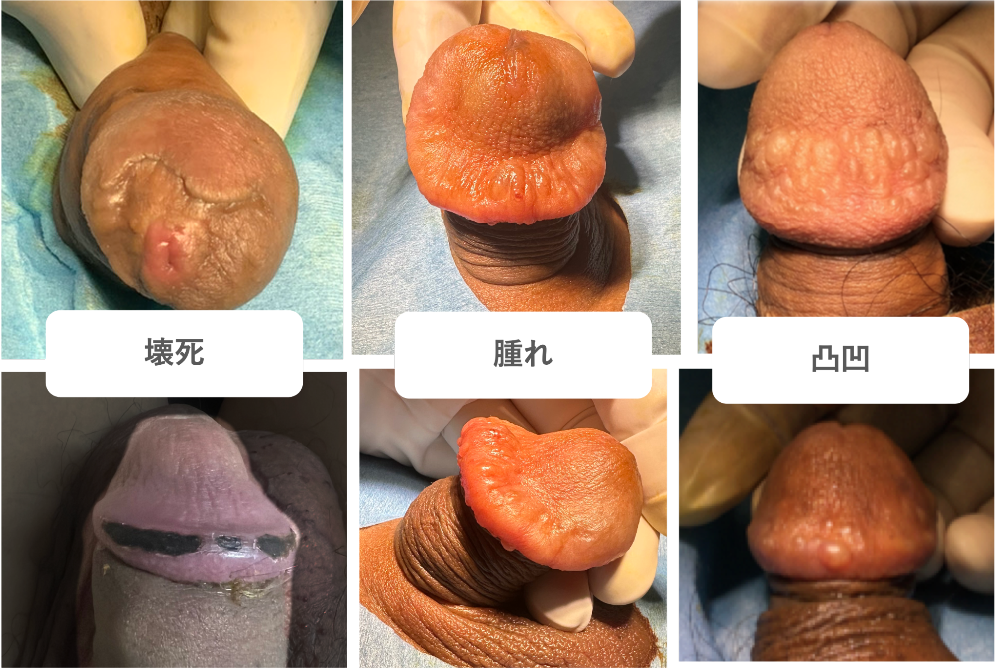亀頭を大きくする他院の施術で失敗れた症例