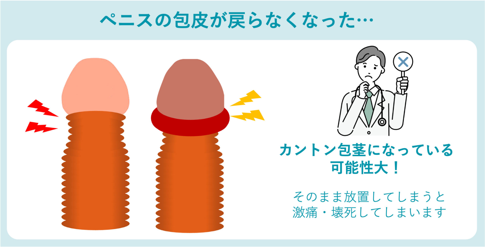 ペニスの包皮が戻らなくなりカントン包茎になったイメージ