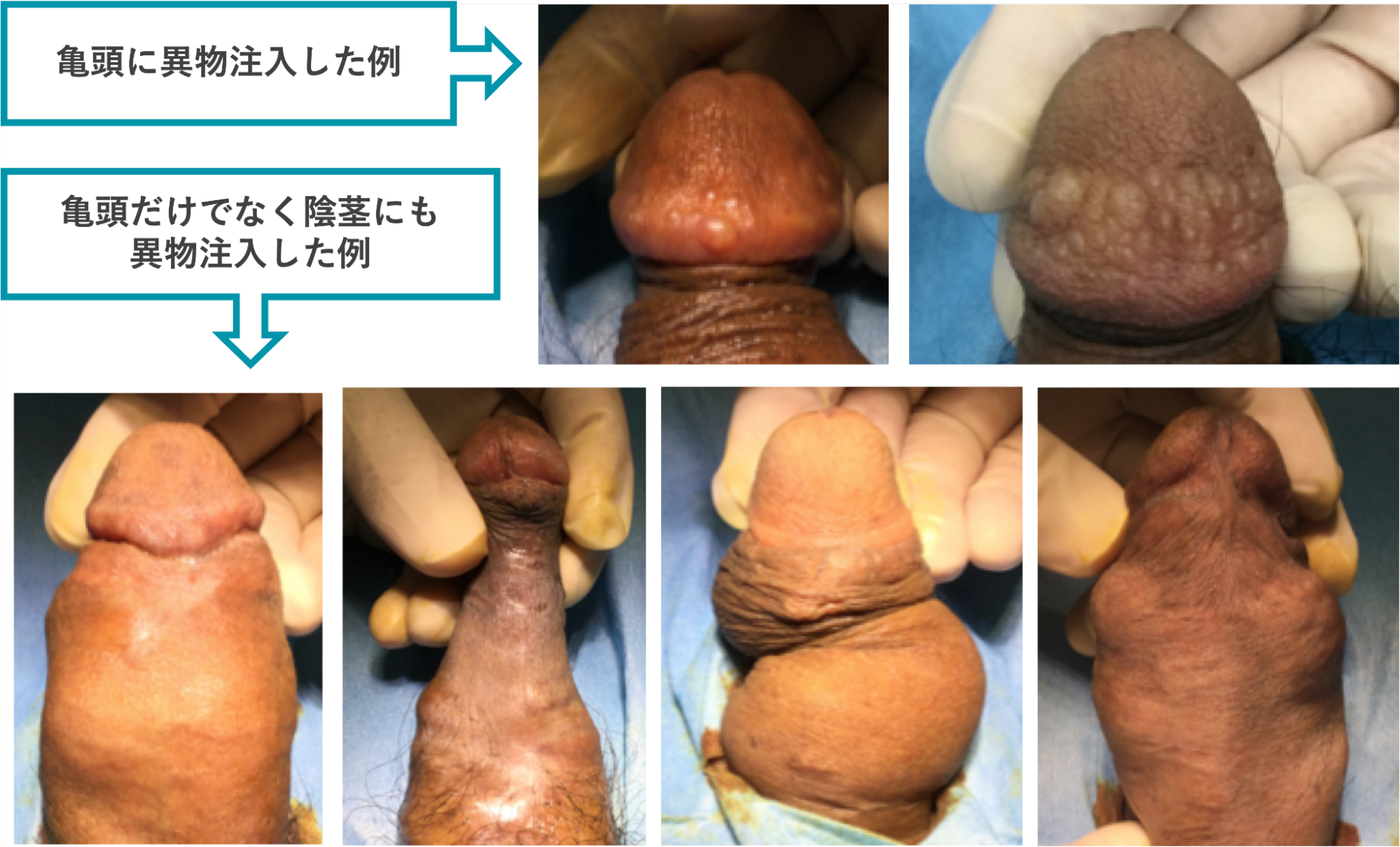 亀頭にヒアルロン酸など注入して失敗した症例