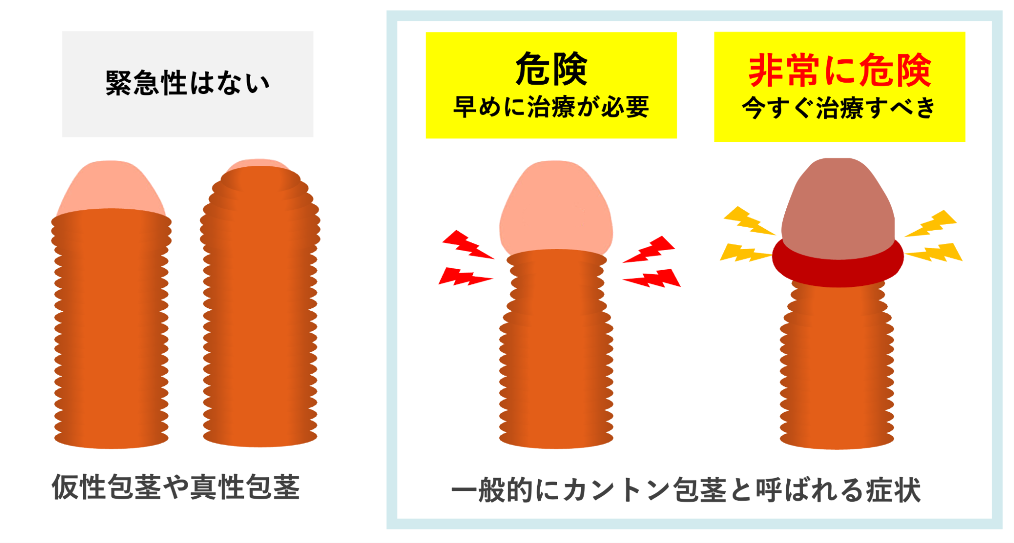 仮性包茎、真性包茎と比べカントン包茎に危険があるイメージ