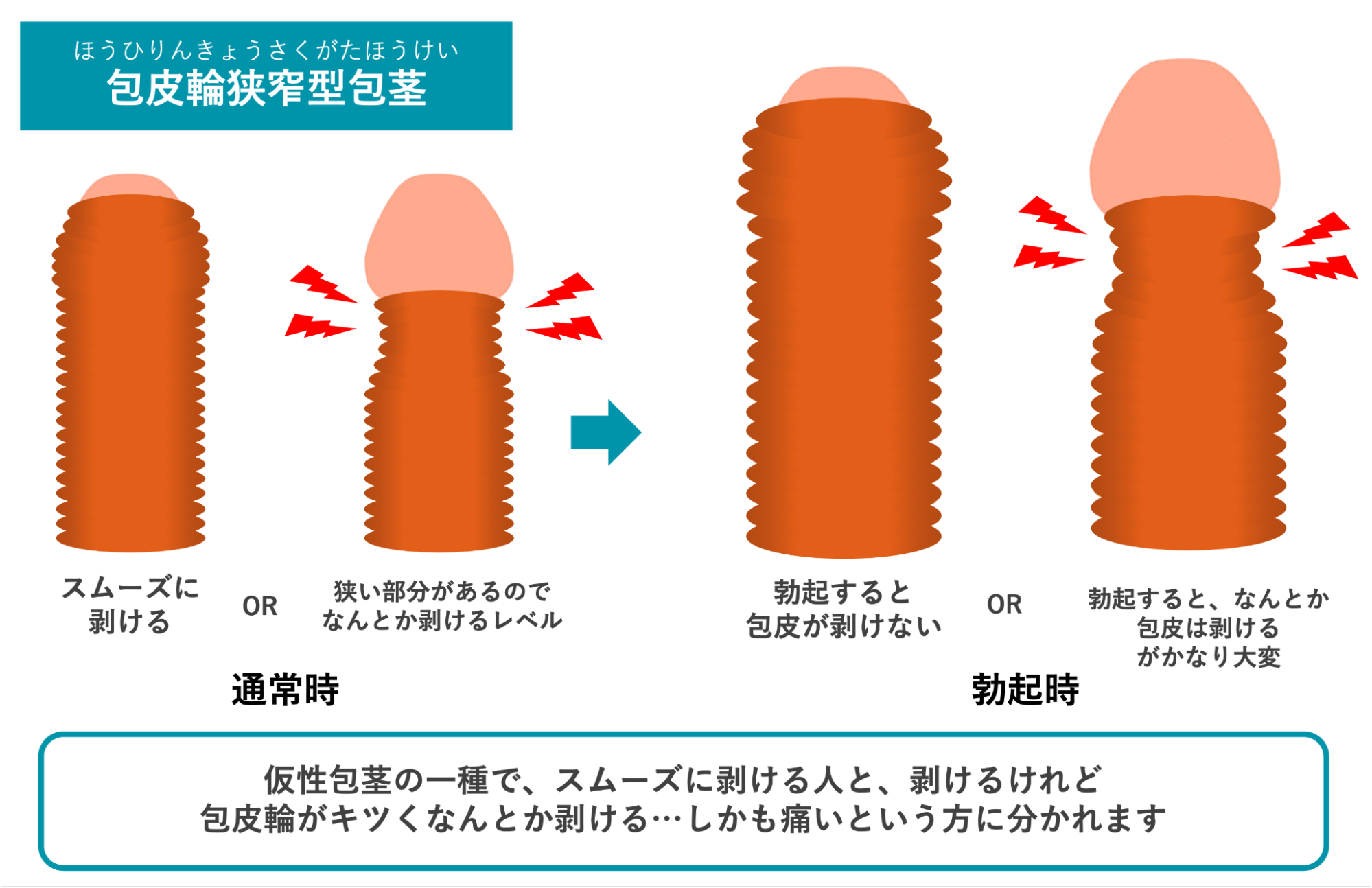包皮輪狭窄型包茎のイメージ