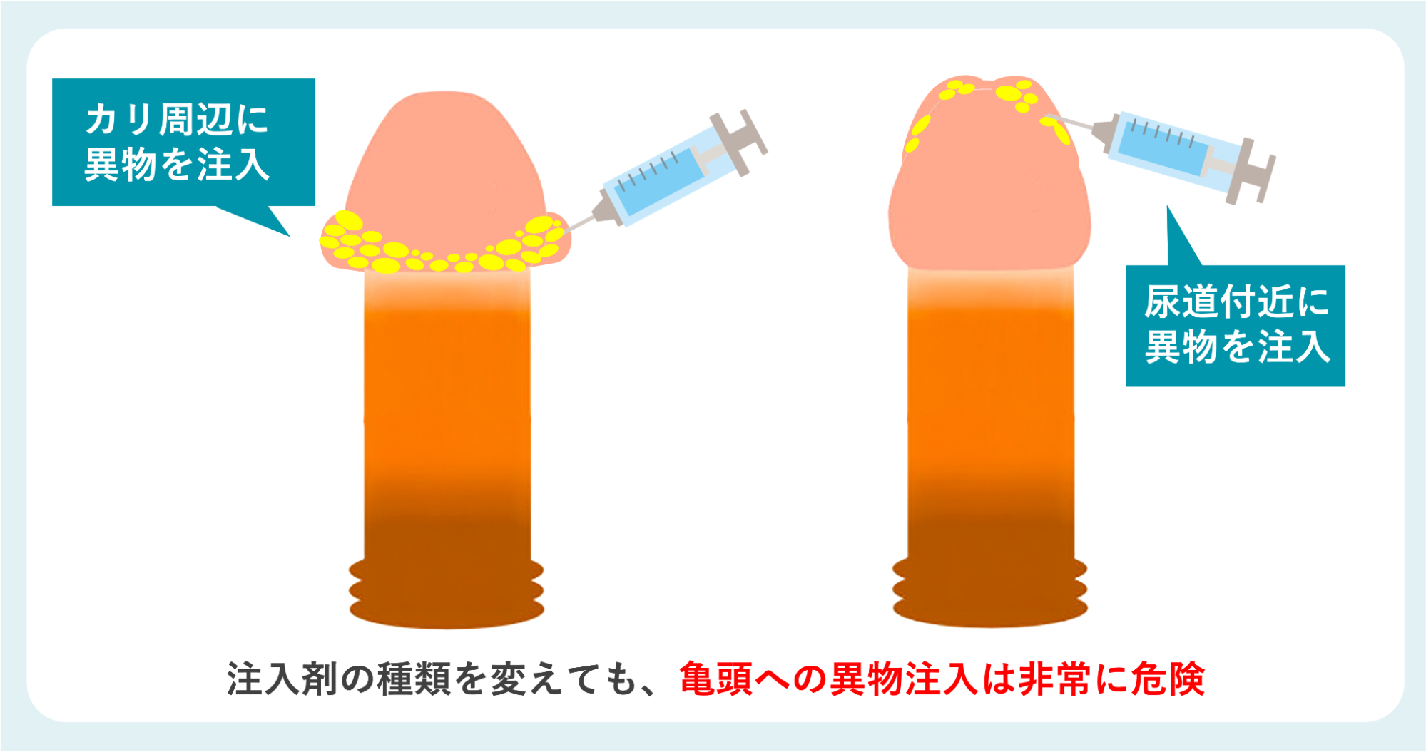 異物注入手術のイメージ
