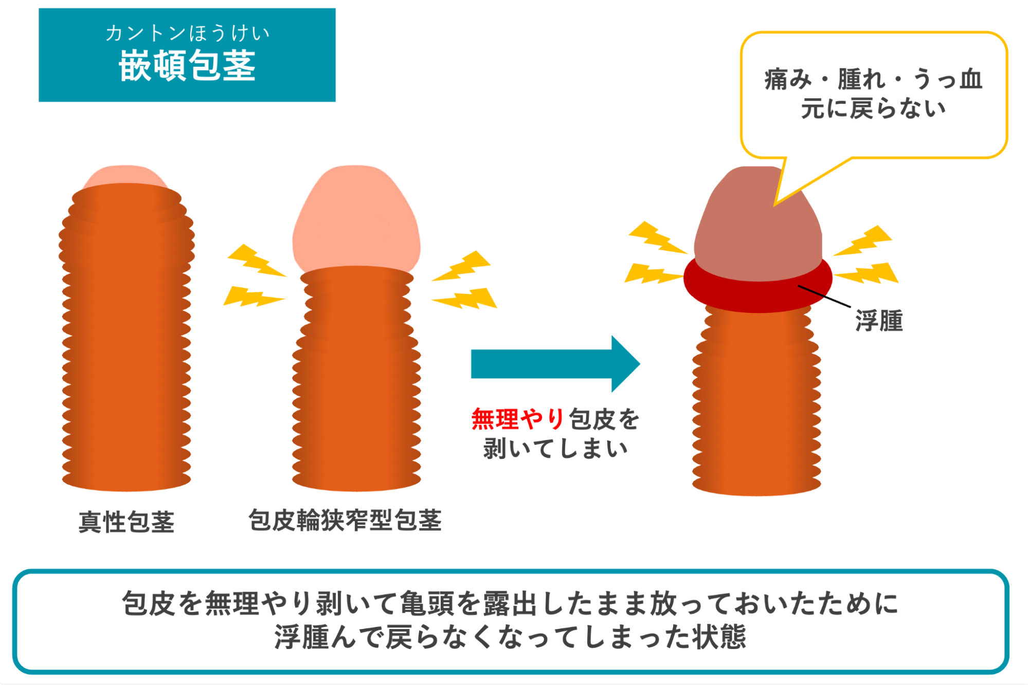 嵌頓包茎のイメージ