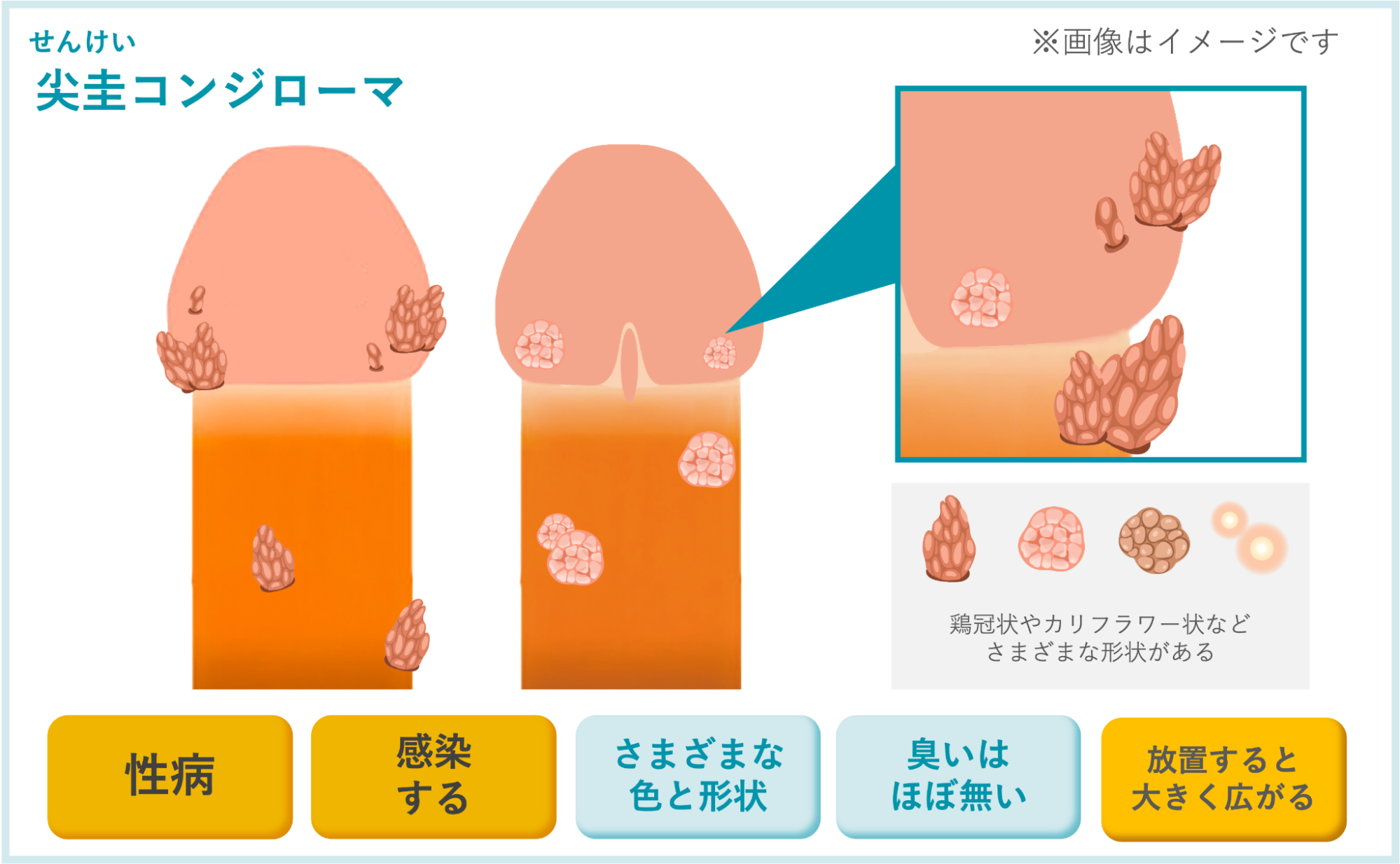 尖圭コンジローマの概要