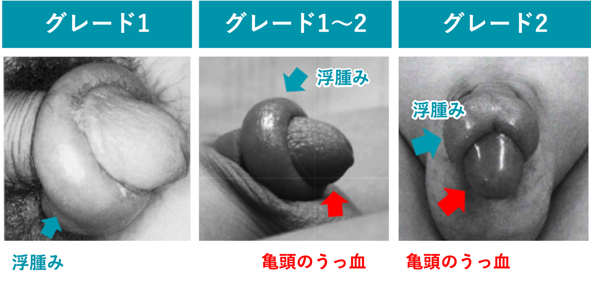 グレード別で見る嵌頓包茎の症状