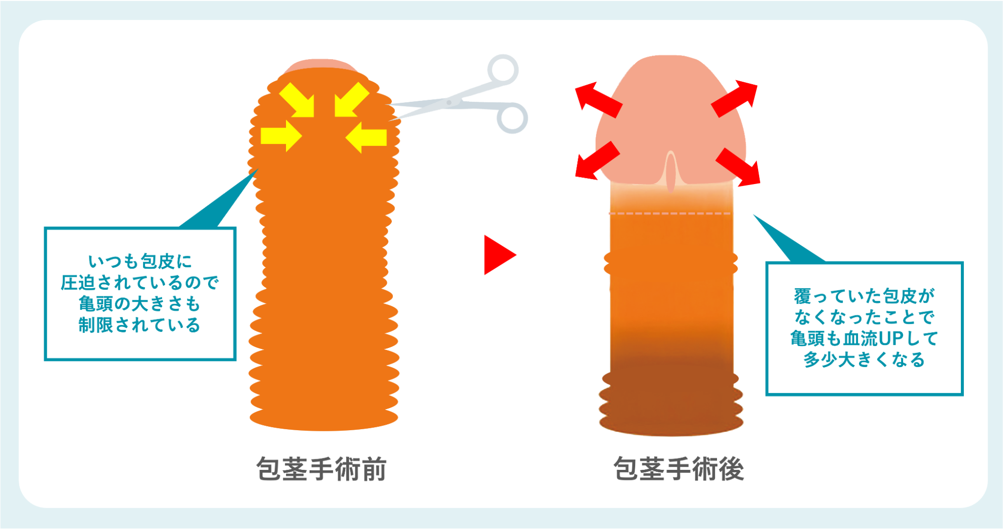 包茎手術のイメージ