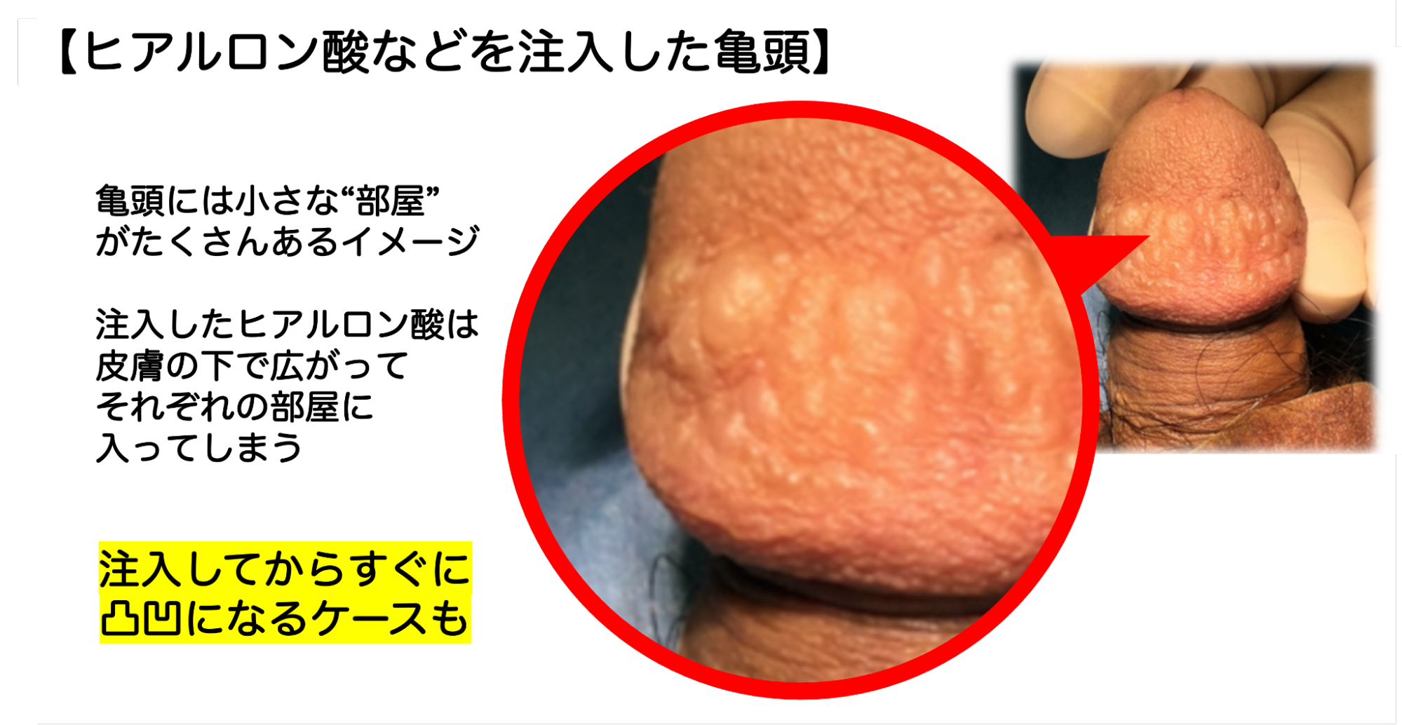 亀頭にヒアルロン酸など注入して失敗した症例